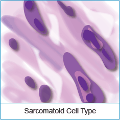 Sarcomatoid Mesothelioma Cell Type